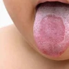 Lưỡi bản đồ là gì? Nguyên nhân, triệu chứng và cách điều trị hiệu quả
