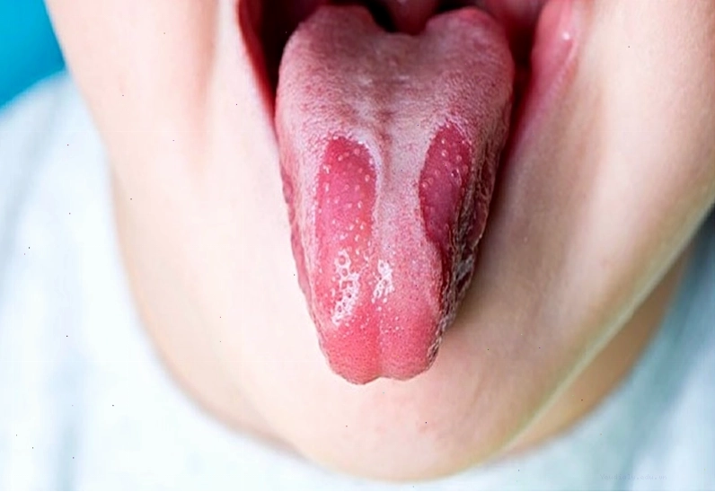 Lưỡi bản đồ có thể xảy ra ở cả trẻ em và người lớn với các mảng đỏ viền trắng