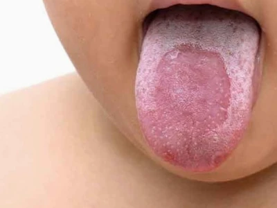 Lưỡi bản đồ là gì? Nguyên nhân, triệu chứng và cách điều trị hiệu quả